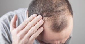 6 טיפולים מומלצים לנשירת שיער והתקרחות